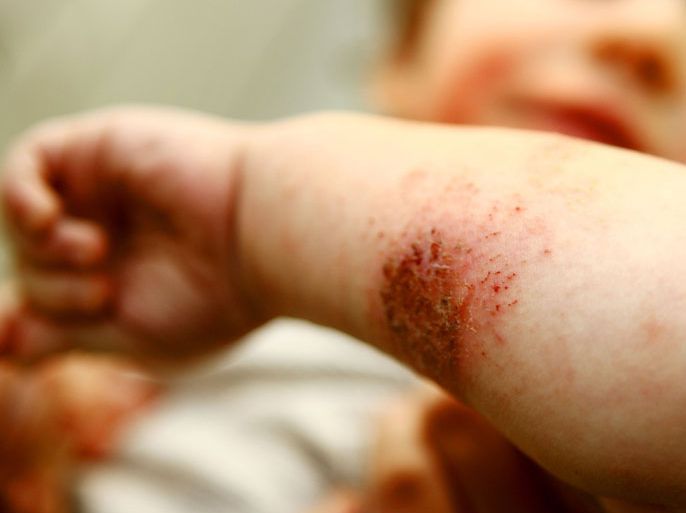 الطفح الجلدي والحكة الشديدة مؤشران على إصابة الطفل بالجرب