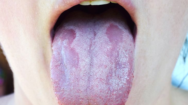 Oral Candidiasis or Oral trush ( Candida albicans), yeast infection on the human tongue close up, common side effect when using antibiotics or another medicaments