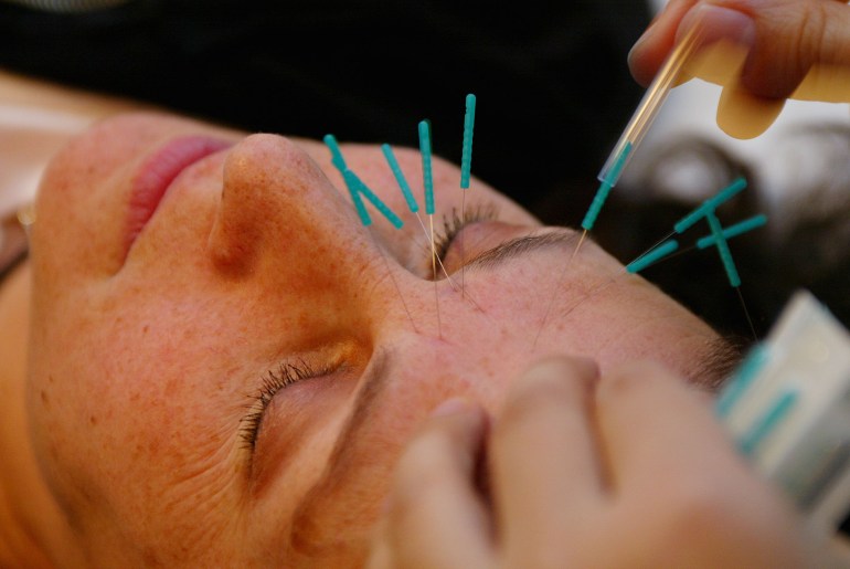 Ping Zhang works on face for acupuncture face lift.