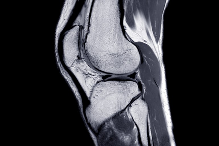 MRI Knee joint or Magnetic resonance imaging sagittal view for detect tear or sprain of the anterior cruciate ligament (ACL). shutterstock_1606280332