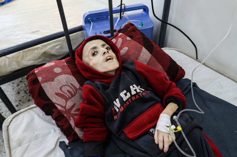 RAFAH, GAZA - FEBRUARY 28: Yezen Al-Kfarna, a 10 year old Palestinian boy who suffers malnourishment due to the ongoing Israeli blockade receives medical treatment with limited resources at Abu Yusuf al-Najjar Hospital in Rafah, Gaza on February 28, 2024. Palestinians are struggling with hunger and malnutrition due to the blockade preventing humanitarian aid from entering. Many Gazan children are in danger of death due to malnutrition. (Photo by Jehad Alshrafi/Anadolu via Getty Images)