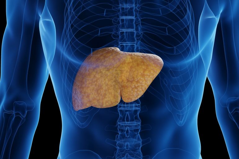 Fatty liver, illustration